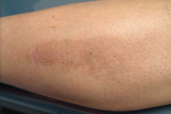 Intense Pulsed Light Laser before 228750