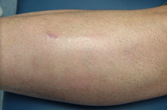 Intense Pulsed Light Laser after 228750