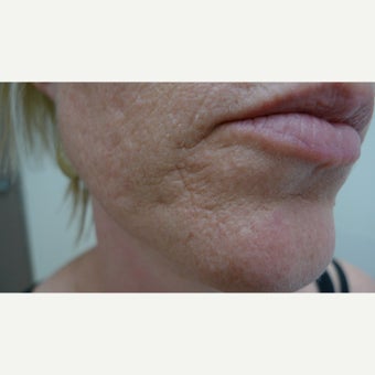 Laser resurfacing can remove scars forever.... before 1853179