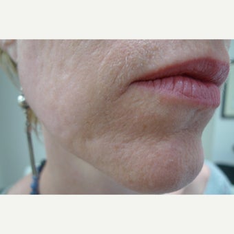Laser resurfacing can remove scars forever.... after 1853179