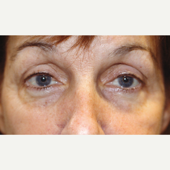45-54 year old woman treated with Drop-and-Lift; complained of a tired appearance. after 3171739