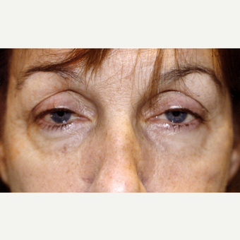45-54 year old woman treated with Drop-and-Lift; complained of a tired appearance. before 3171739
