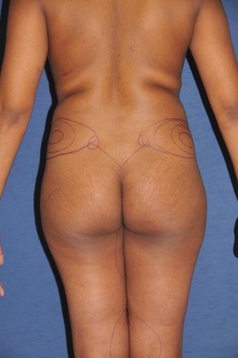 Brazilian Buttock lift before 525445