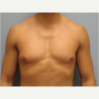 18-24 year old man treated with Male Breast Reduction before 3736977