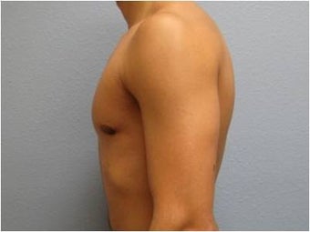 18-24 year old man treated with Male Breast Reduction 3736977