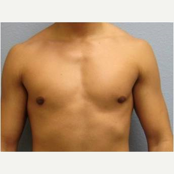 18-24 year old man treated with Male Breast Reduction after 3736977