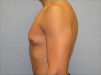 18-24 year old man treated with Male Breast Reduction 3736977
