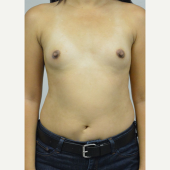 35-44 year old woman treated with Breast Implants before 3005059