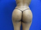 Petite Patient with Butt Augmentation with Fat Grafting after 1118287