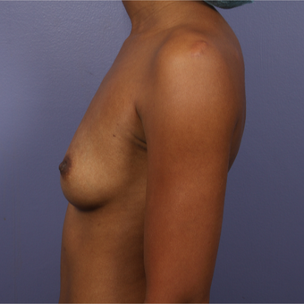 25-34 year old woman treated with Breast Augmentation before 3226387