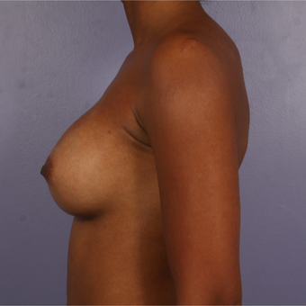 25-34 year old woman treated with Breast Augmentation after 3226387