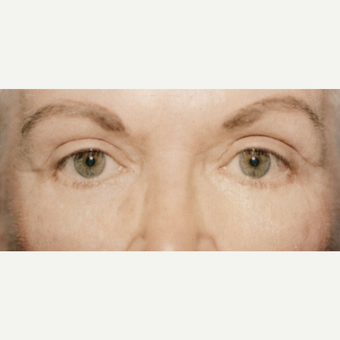 55-64 year old woman treated with Eyelid Surgery after 3441095