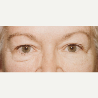 55-64 year old woman treated with Eyelid Surgery before 3441095