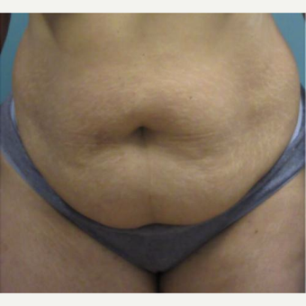 35-44 year old woman treated with Laser Liposuction before 3764397