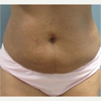 35-44 year old woman treated with Laser Liposuction after 3764397