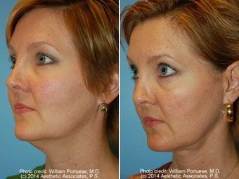 Neck Liposuction before 212296