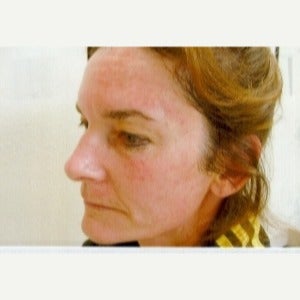55-64 year old woman treated with Photodynamic Therapy before 2571744