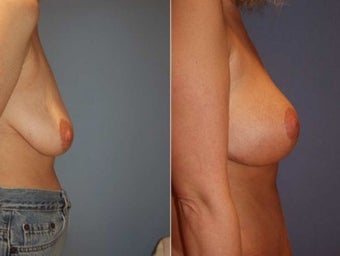 37yo Dr Mark Prysi performesd breast lift with implants before 1245714