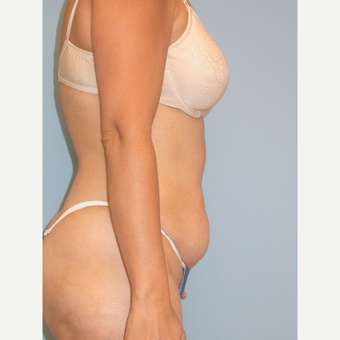 41 year old woman treated with Tummy Tuck before 3142100