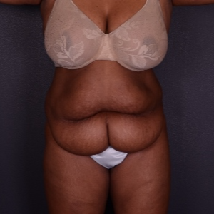 45-54 year old woman treated with Tummy Tuck before 3069913