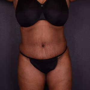 45-54 year old woman treated with Tummy Tuck after 3069913
