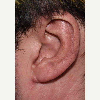 Macrotia Reduction Surgery after 3786667