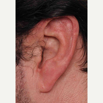 Macrotia Reduction Surgery before 3786667