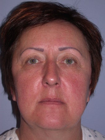 Eyelid Surgery/Blepharoplasty before 653457
