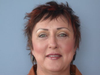 Eyelid Surgery/Blepharoplasty after 653457