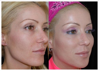 Before and After Sculptra after 1031290