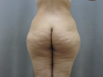 45 year old woman presented for improvement of her contour. before 1111736