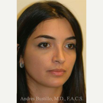 31 year old woman treated with Rhinoplasty after 3460855