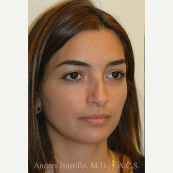 31 year old woman treated with Rhinoplasty before 3460855
