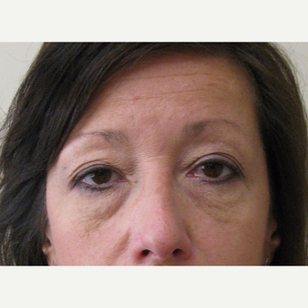 45-54 year old woman treated with Eyelid Surgery before 3439683