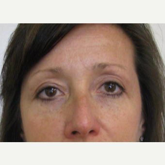 45-54 year old woman treated with Eyelid Surgery after 3439683