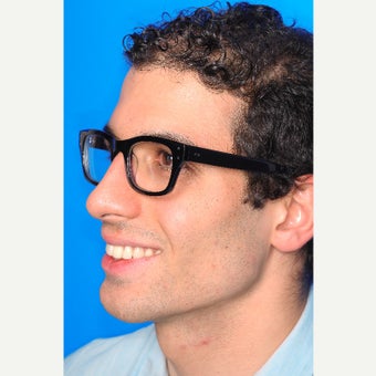25-34 year old man treated with Chin Surgery and Jawline Enhancement after 2344034