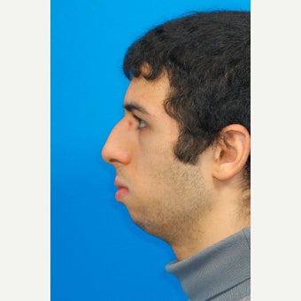 25-34 year old man treated with Chin Surgery and Jawline Enhancement before 2344034