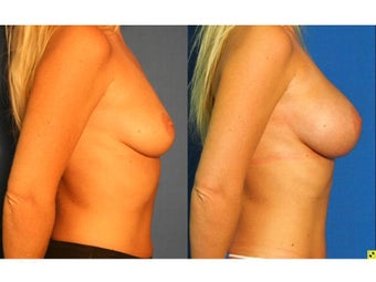 Fat Transfer Breast Augmentation after 1228050