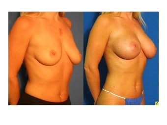 Fat Transfer Breast Augmentation before 1228050