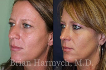 39 year-old female before and 9 months after Rhinoplasty before 3447133