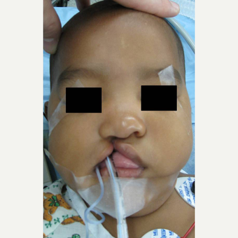 Cleft Lip And Palate Repair before 3711060