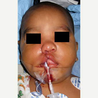 Cleft Lip And Palate Repair after 3711060