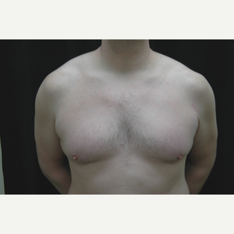 35-44 year old man treated with Male Breast Reduction before 3181905