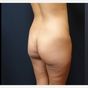 25-34 year old woman treated with Butt Augmentation before 3731684