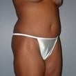 Female patient who received surgery after major weight loss 960988