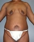 Female patient who received surgery after major weight loss before 960988