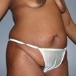 Female patient who received surgery after major weight loss 960988