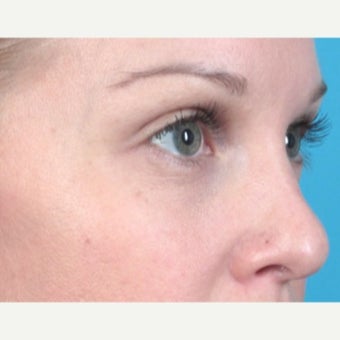 25-34 year old woman treated with Belotero after 2277272