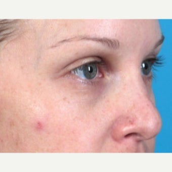 25-34 year old woman treated with Belotero before 2277272