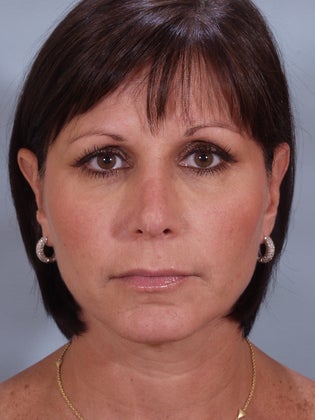 Revision Rhinoplasty after 876688